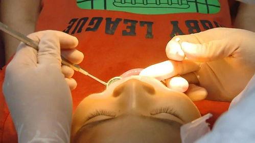 拔牙视频全过程,拔牙手术的惊心动魄瞬间