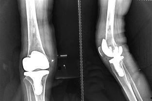 膝关节置换视频,从术前准备到术后康复