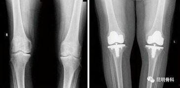 膝关节置换视频,从术前准备到术后康复